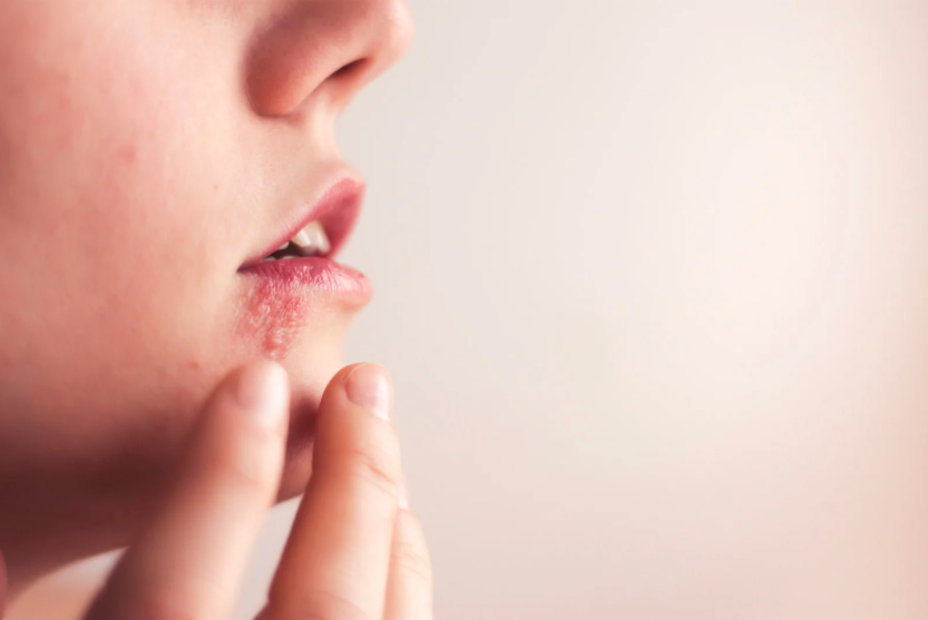 Lippenherpes am ersten Tag
